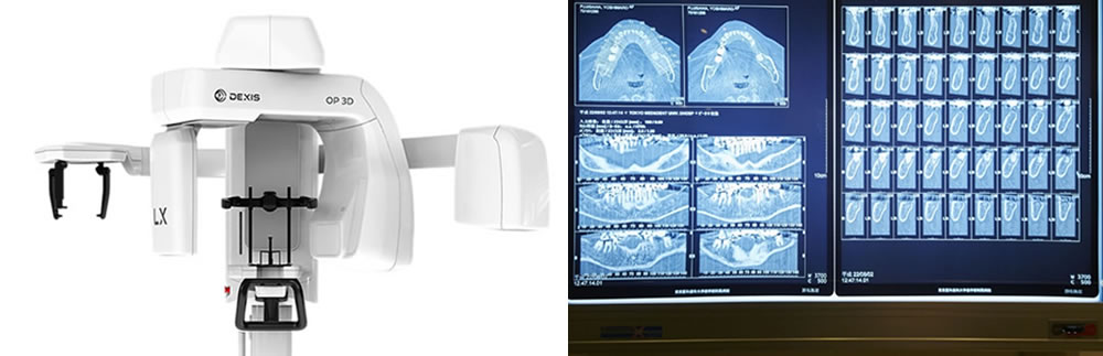 歯科用CT検査