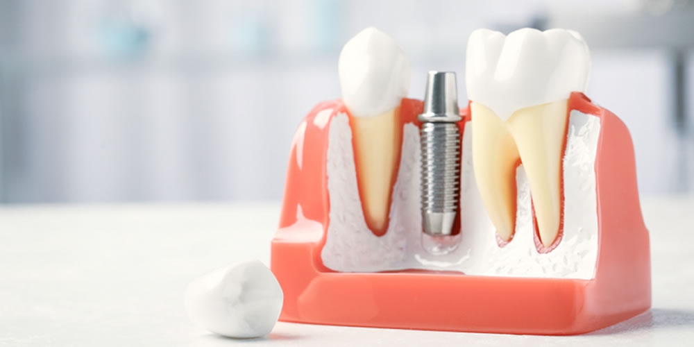 治療やインプラント体の質が低い可能性