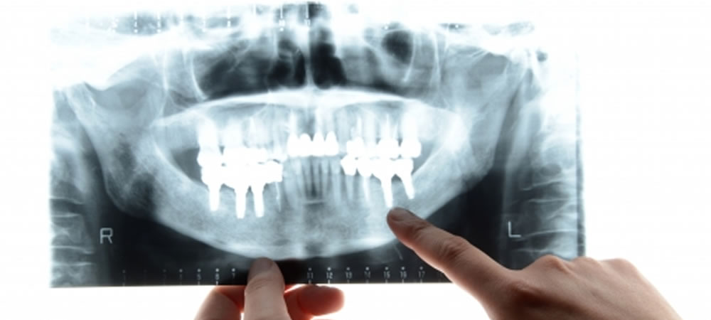 インプラント治療で後悔しない歯科医院の選び方