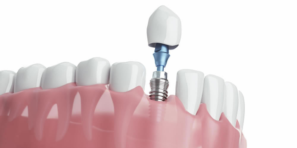 ブリストデンタルクリニック三郷が提供する質の高いインプラント治療