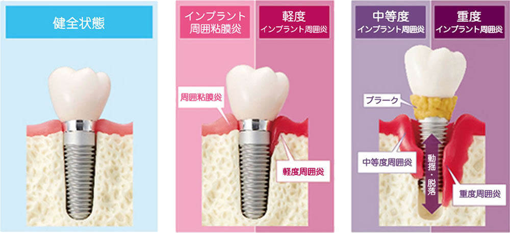 インプラント周囲炎