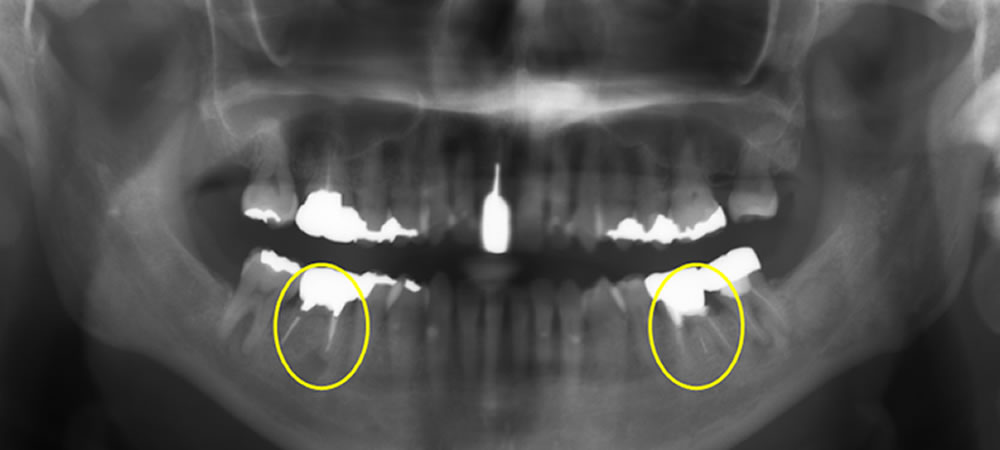 初診時のレントゲン