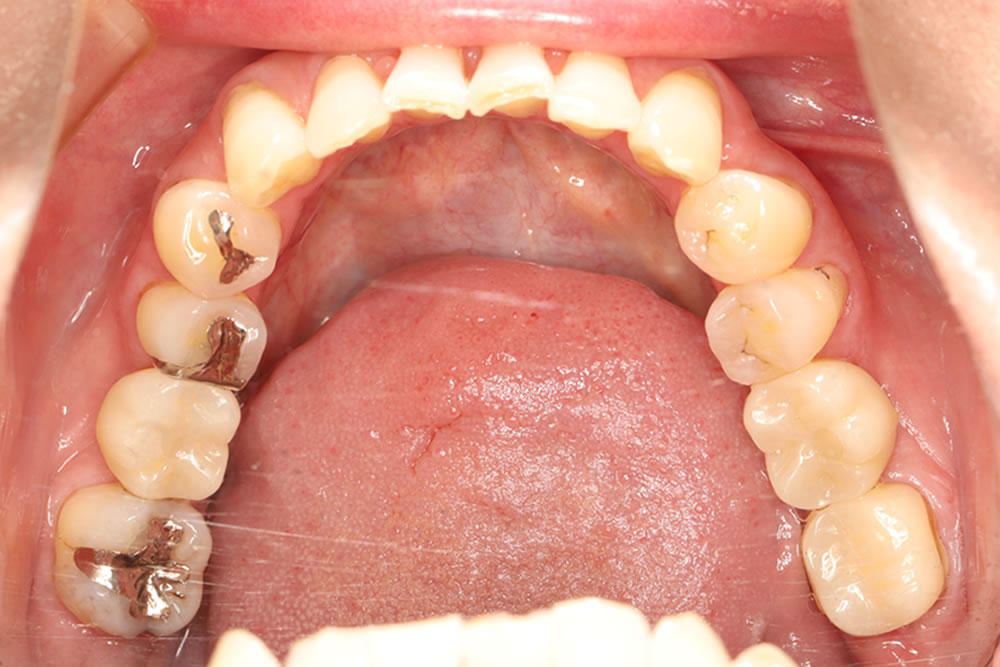 上部構造の装着・治療完了