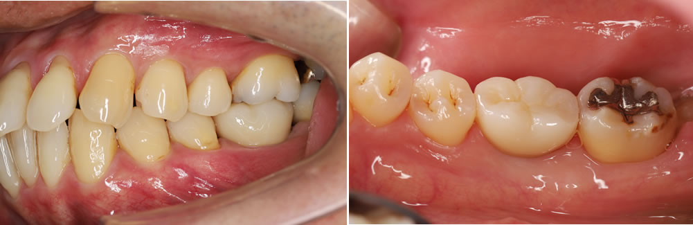 保存不可能な歯を抜歯後にインプラントで治療した症例