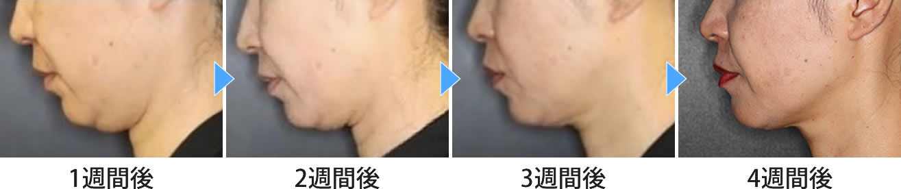 脂肪溶解注射の症例