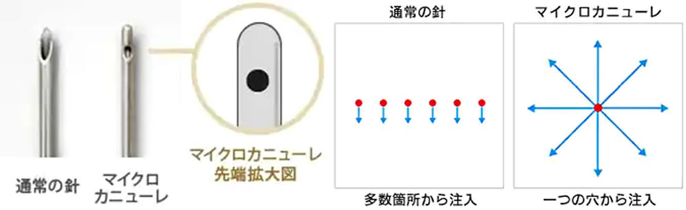 ヒアルロン注射で使用する注射針