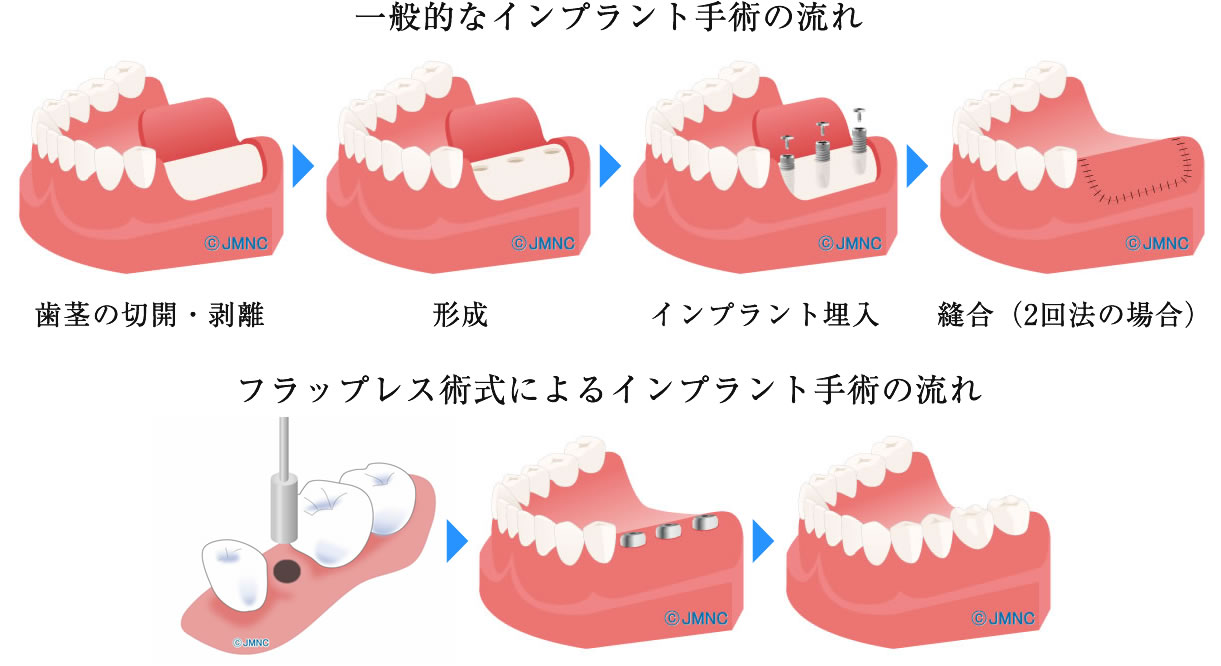 切らない・縫わない・負担の少ないフラップレス手術