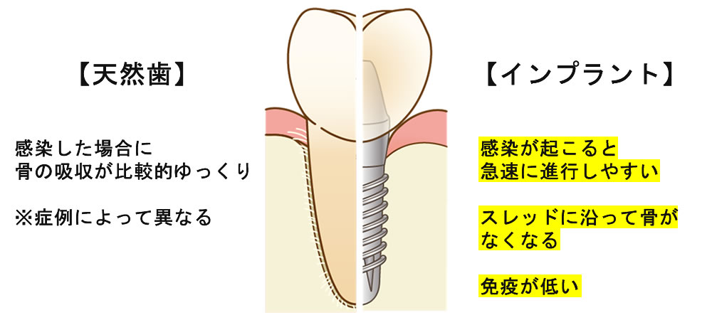 インプラントと天然歯の細菌感染に関する違い