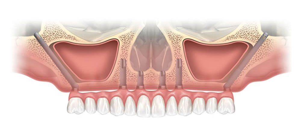 ザイゴマインプラント