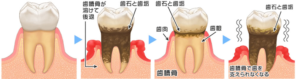 歯周病の進行の様子
