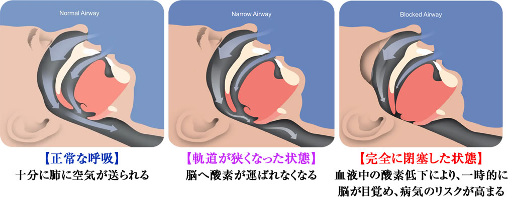 睡眠時無呼吸症候群ってどんな病気？